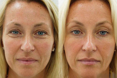 Botox Facial