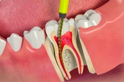 Endodontia em Santo André